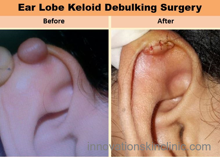Ear Lobe Keloid Surgery 2