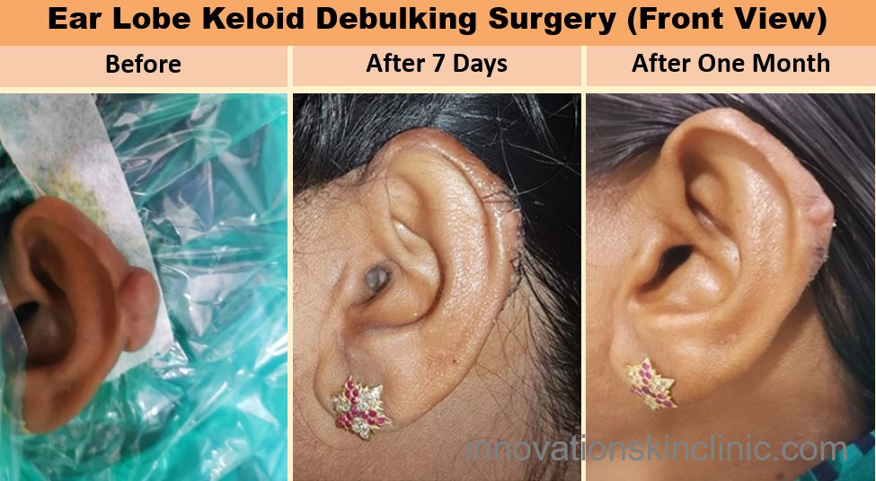 Ear Lobe Keloid Surgery 1 Front