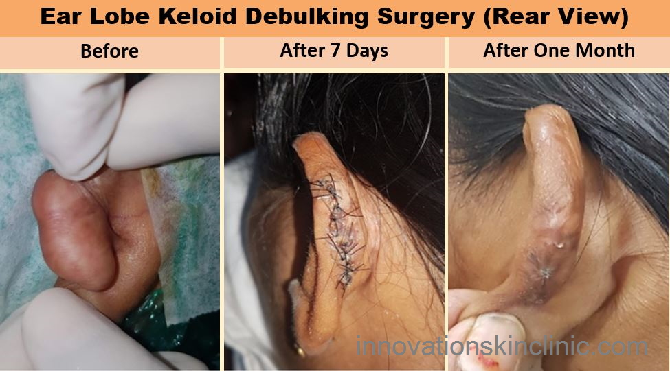 Ear Lobe Keloid Surgery 1 Rear