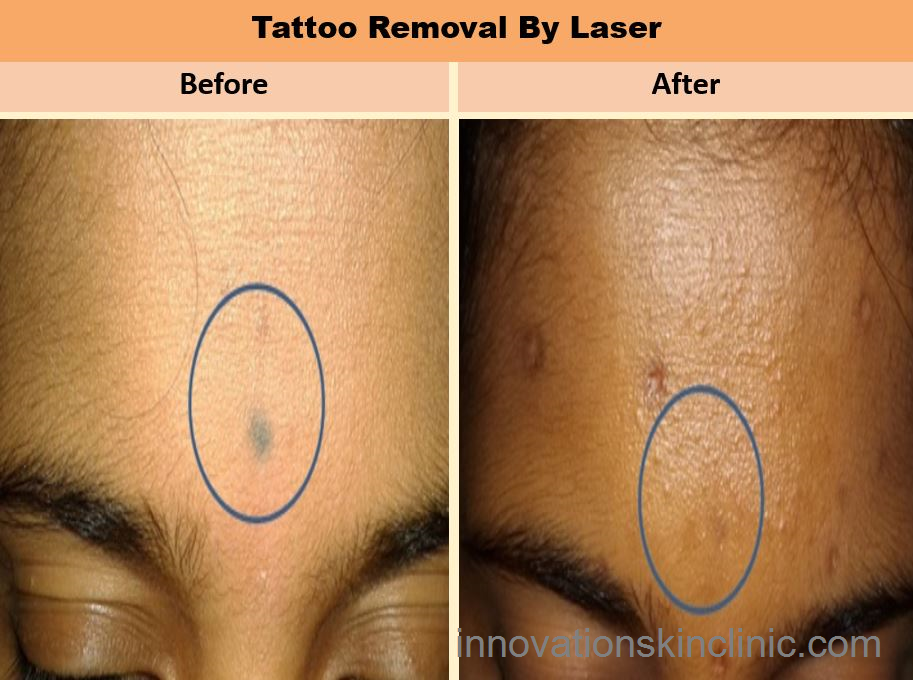 Lasers For Tattoo