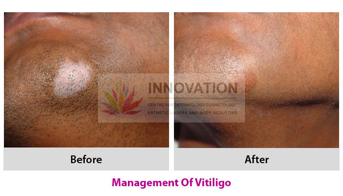 Vitiligo Surgery 5