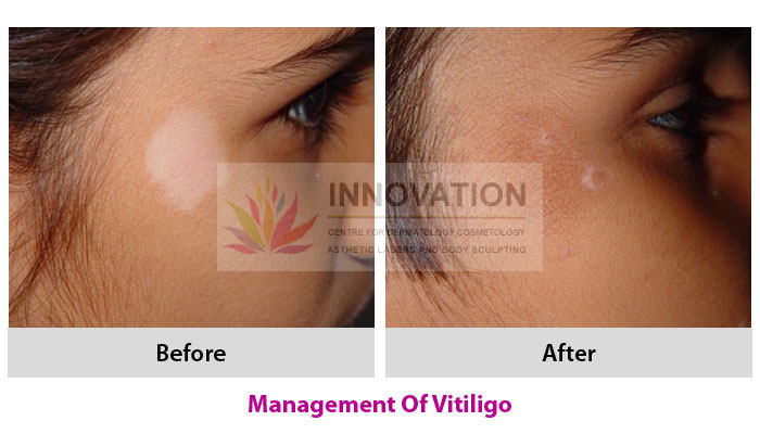 Vitiligo Surgery 6