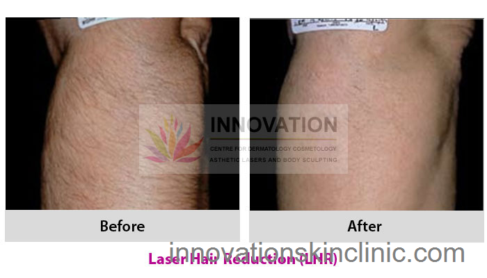 Laser Hair Reduction Treatment 6